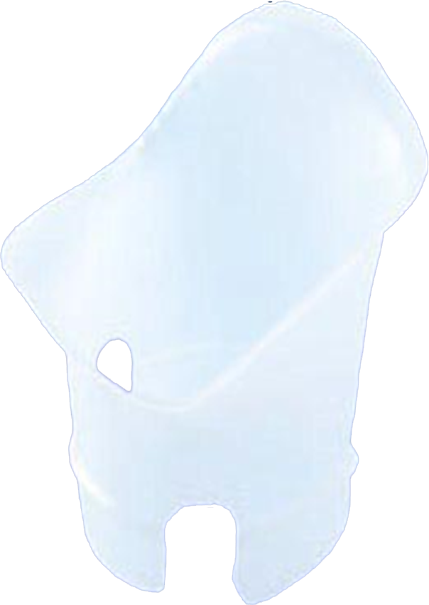 Above knee casting ring set, version ischial